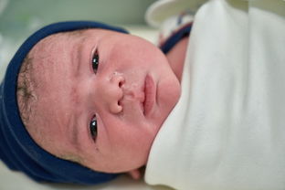 怀孕妊娠合并新生儿粘脂贮积症III型怎么对症支持_